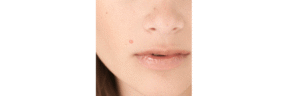 Acne: What To Know