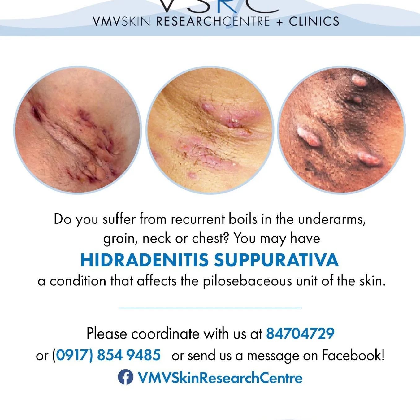Dermatological research is who we are! 🥥 

VMV Skin-Research Centre + Clinics is currently screening possible participants for a study on Hidradenitis Suppurativa (HS).
 
HS is a chronic recurrent condition characterized by chronic and recurrent inflammatory nodules, sinus formation, presence of discharge and keloid formation in the body fold such as the armpits, inframammary, neck, buttock and groin areas. 
 
If you know someone who might have this condition (always having recurrent “ pimple” or “pigsa” in these areas) you may refer them to VSRC or contact us at +63 915 976 5664